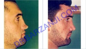 ترمیم بینی