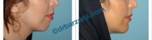 عمل جراحی پروتز چانه