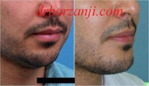 پروتز چانه