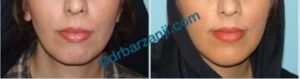 عمل جراحی پروتز چانه