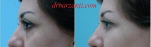 تزریق ژل بلوترو در فرورفتگی زیر چشم