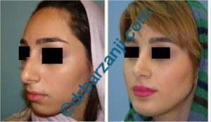 جراحی بینی و پروتز چانه چهار سال بعد از عمل