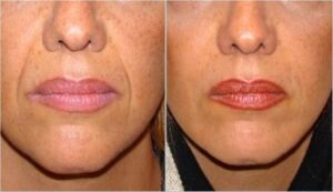 تزریق ژل جوویدرم در خط خنده