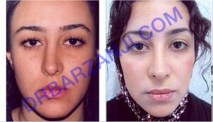 ترمیم بینی
