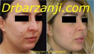 پروتز چانه و زاویه فک